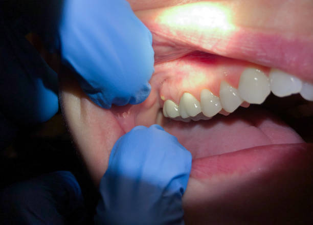 Best Urgent Care for Lost Fillings or Crowns in Bellevle, IL