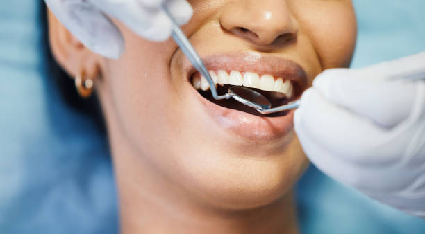 Best Emergency Wisdom Teeth Removal in Bellevle, IL